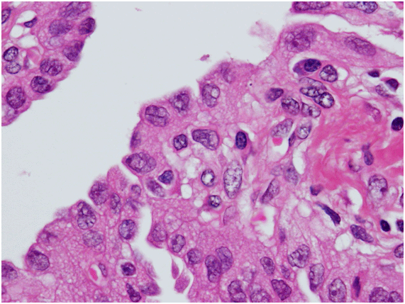 Papillary carcinoma
